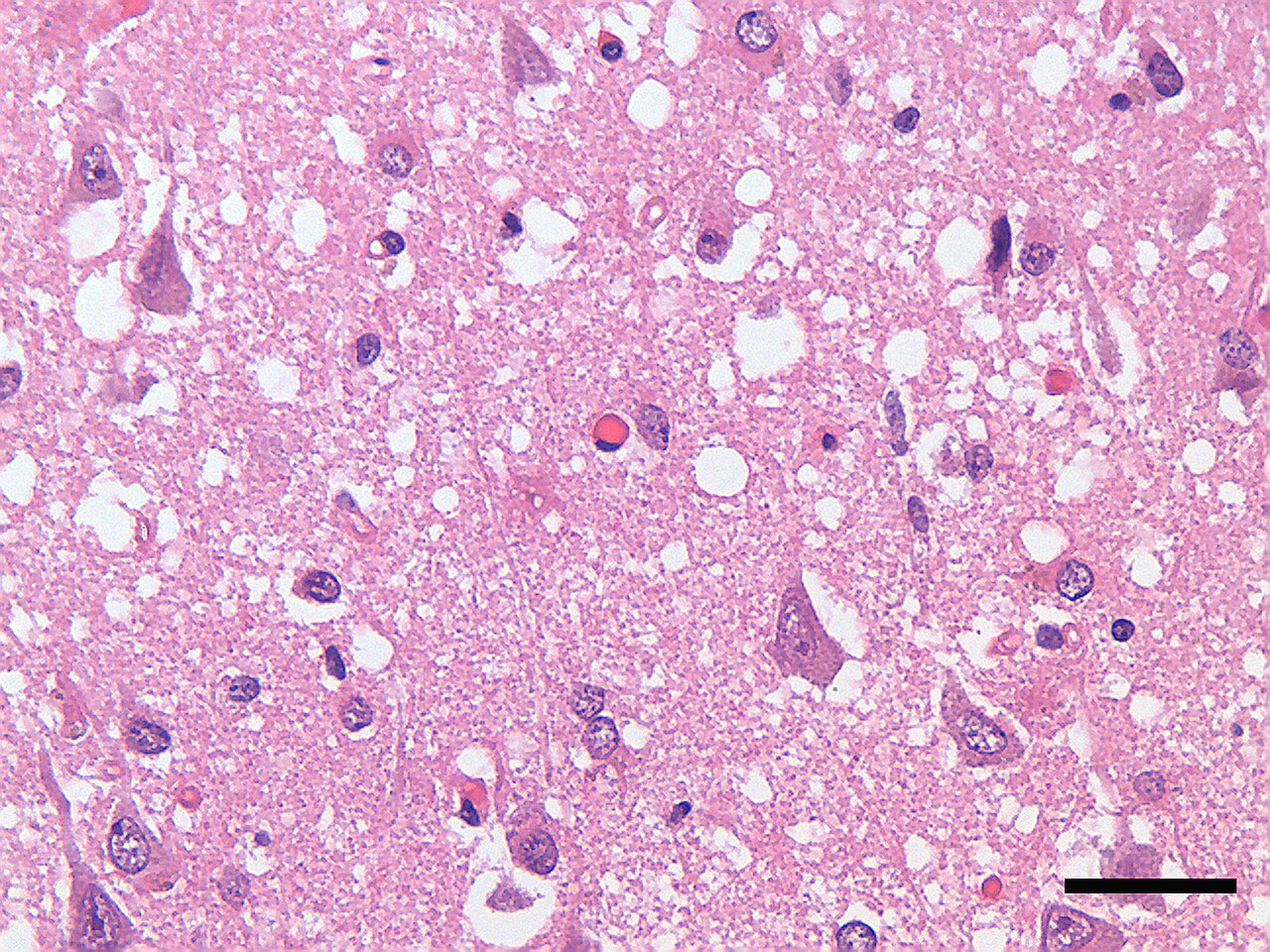 Corte de córtex cerebral corado com hematoxilina e eosina mostrando vacúolos da degeneração espongiforme